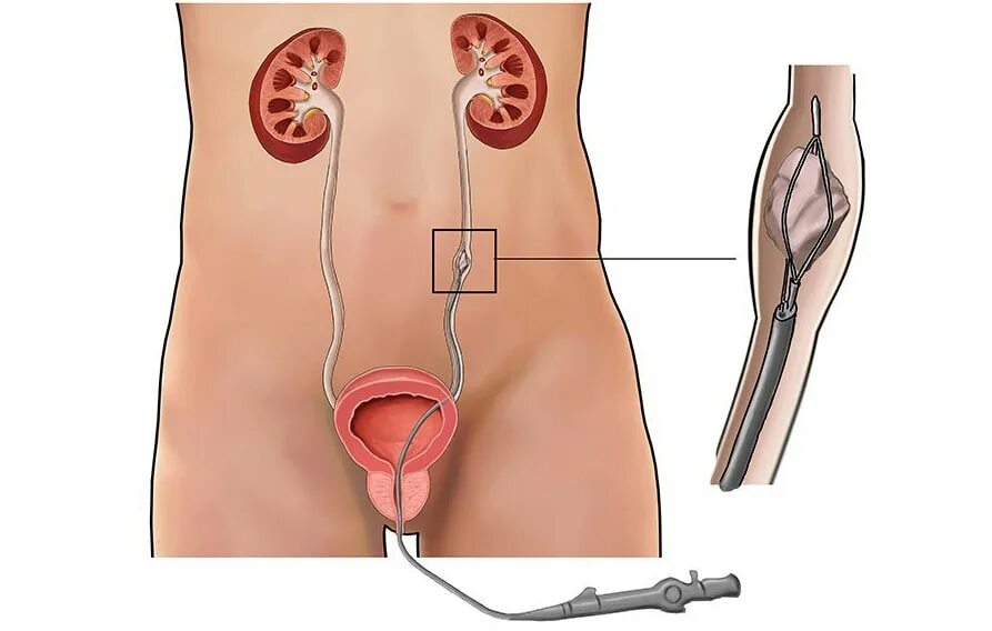 Катетер стент мочеточниковый. Камень в мочеточнике уретероскопия. Уретроскопия камни в мочеточнике. Снятии стента