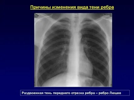 Ребро люшке