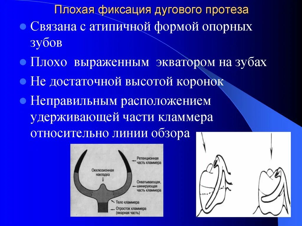 Ошибка протезирование