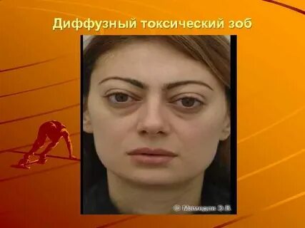 Токсический зоб