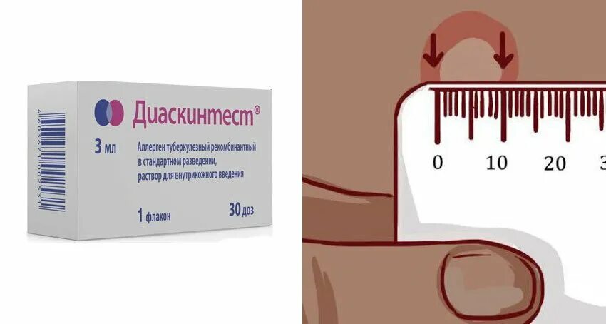 Диаскинтест что это. Реакциянадлиаскинтест. диаскинтест оценка результатов.