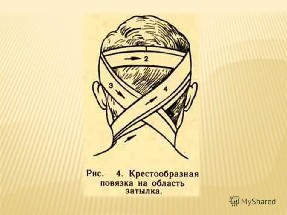 Крестообразная на затылок. Техника наложения крестообразной повязки на затылок. Десмургия. Повязка крестообразная на затылок.. Крестообразная повязка на затылок алгоритм. Крестообразная повязка на затылок и шею алгоритм.