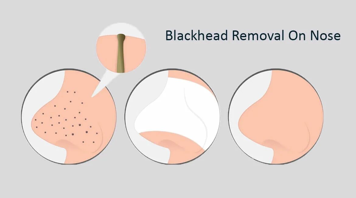 Blackhead remover перевод