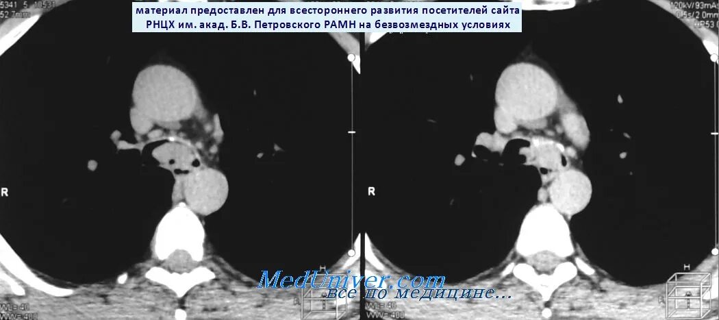 Рак трахеи тест. Рак трахеи тест