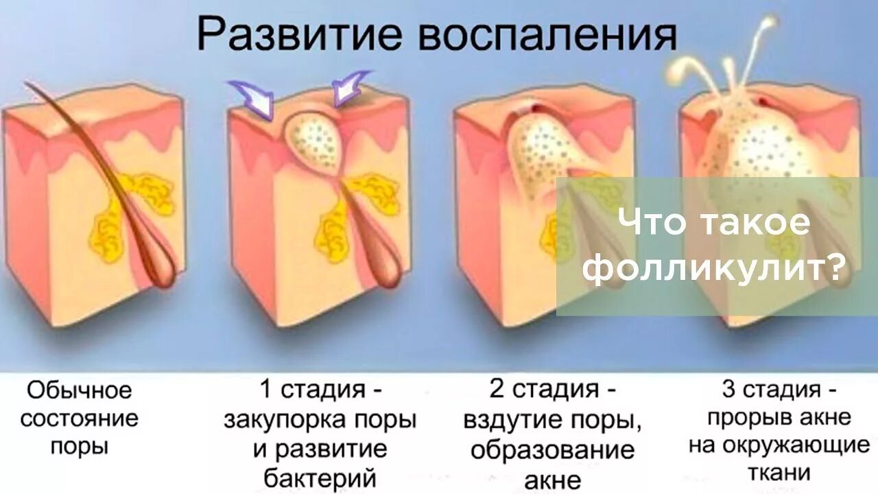 Фолликулит воспаление сальной железы. Акне схема образования. Папуло пустулезная форма акне. Неприятная пора