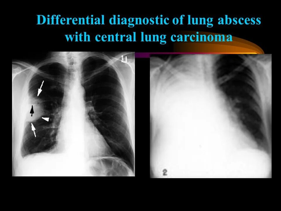 Диагноз абсцесс легкого. Центральный и периферический абсцесс легкого. Абсцесс легкого дифференциальная диагностика. Диф диагноз абсцесса легкого. Центральный абсцесс лёгкого.