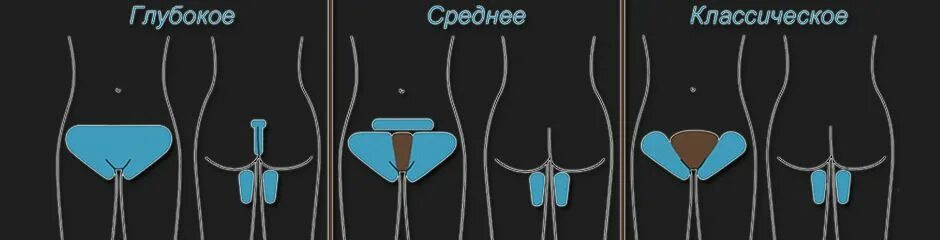 Чем отличается бикини от тотального бикини. Зона депиляции тотальное бикини. классическое и тотальное бикини разница. зона бикини классика и глубокое бикини разница. зона классического бикини.
