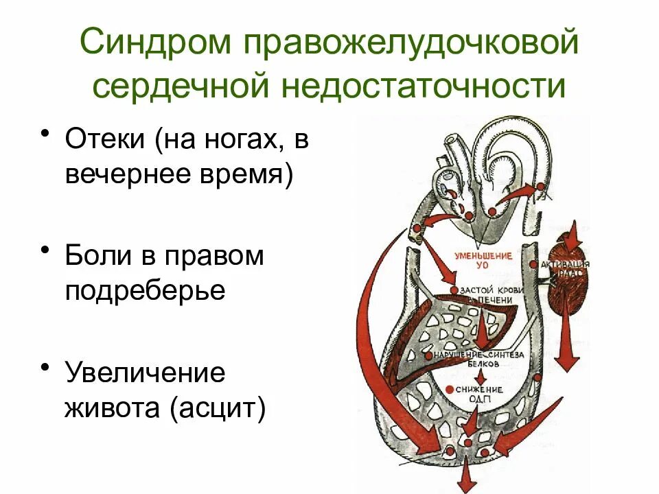 Отеки при хсн. Механизм развития правожелудочковой недостаточности. Причины острой правожелудочковой сердечной недостаточности. Хроническая правожелудочковая сердечная недостаточность патогенез. Синдром правожелудочковой недостаточности пропедевтика.