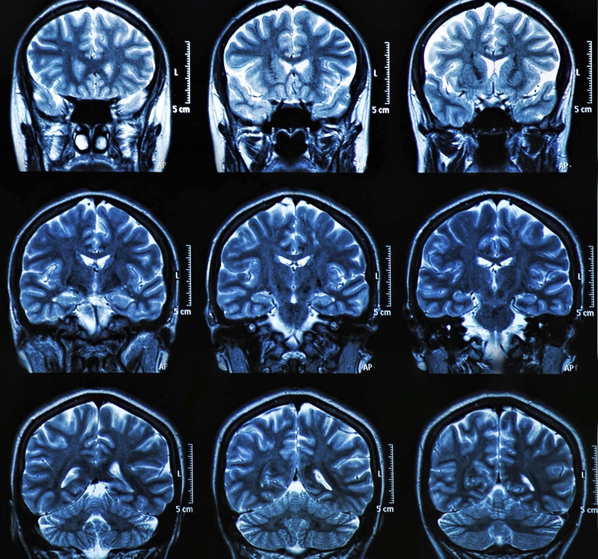 Мрт с контрастом головного. MRI головного мозга. Мрт головного мозга снимки. Снимок головного мозга здорового человека. Мрт головы с контрастом.