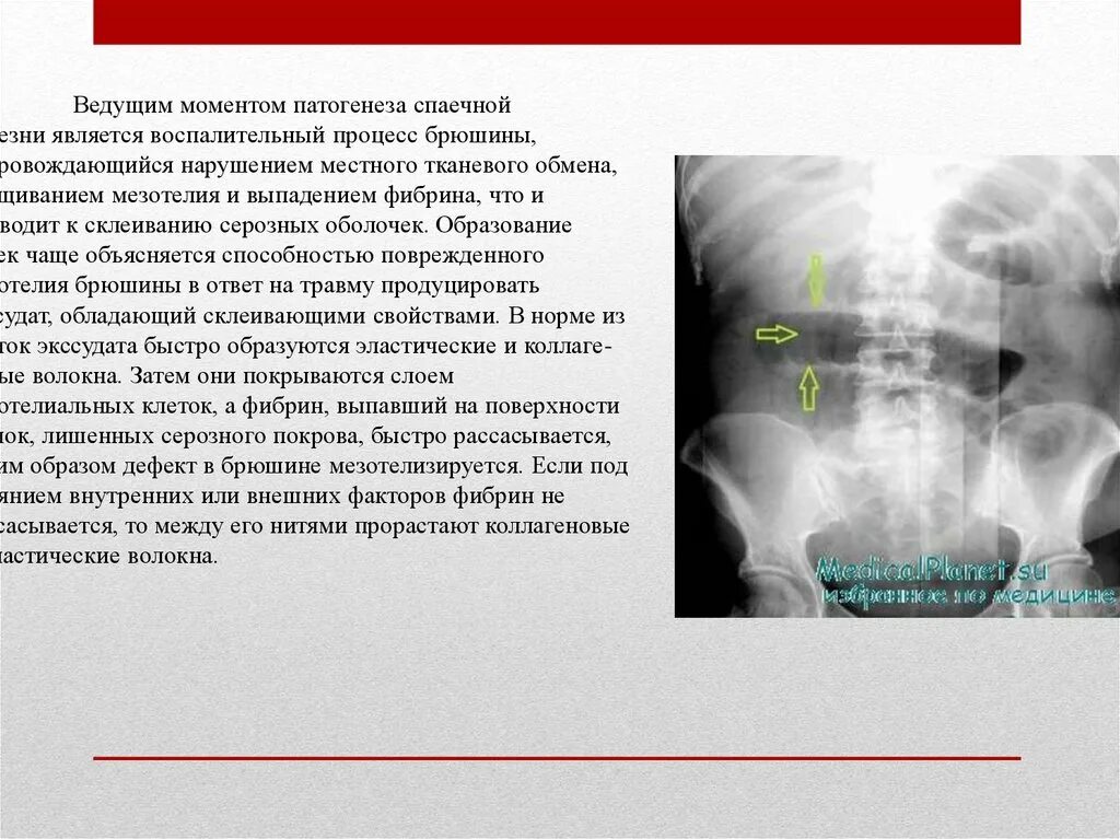 Спайки код по мкб 10