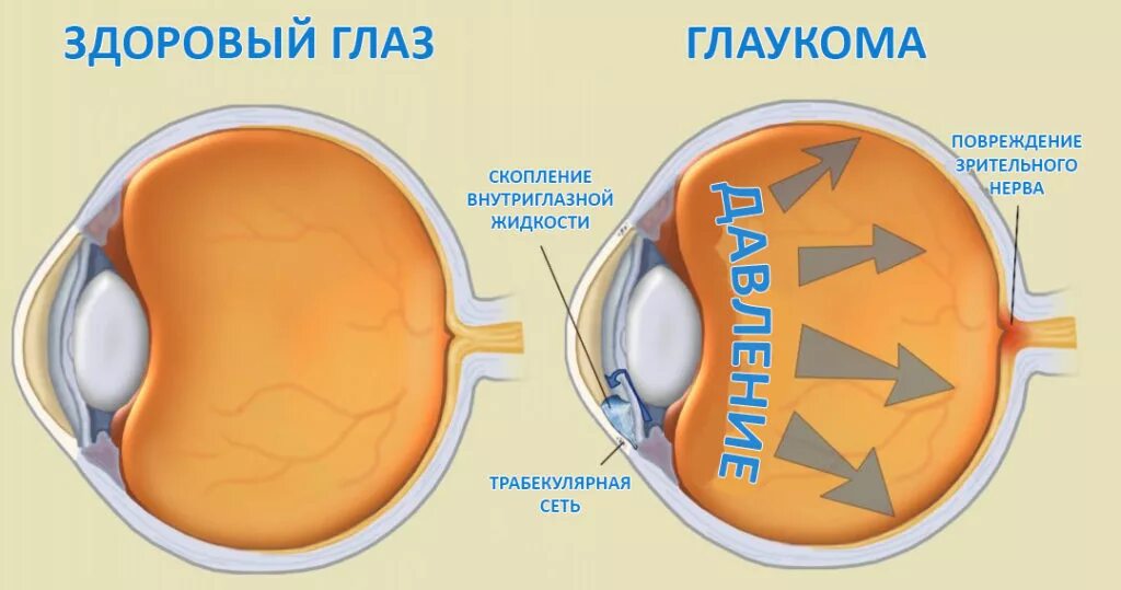 Внутриглазное давление лечение. Глаукома схема. Здоровые глаза. Глаукома схема глаза. Как выглядит здоровый глаз.