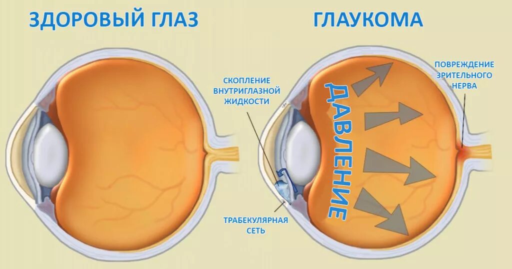 Повышение внутриглазного давления