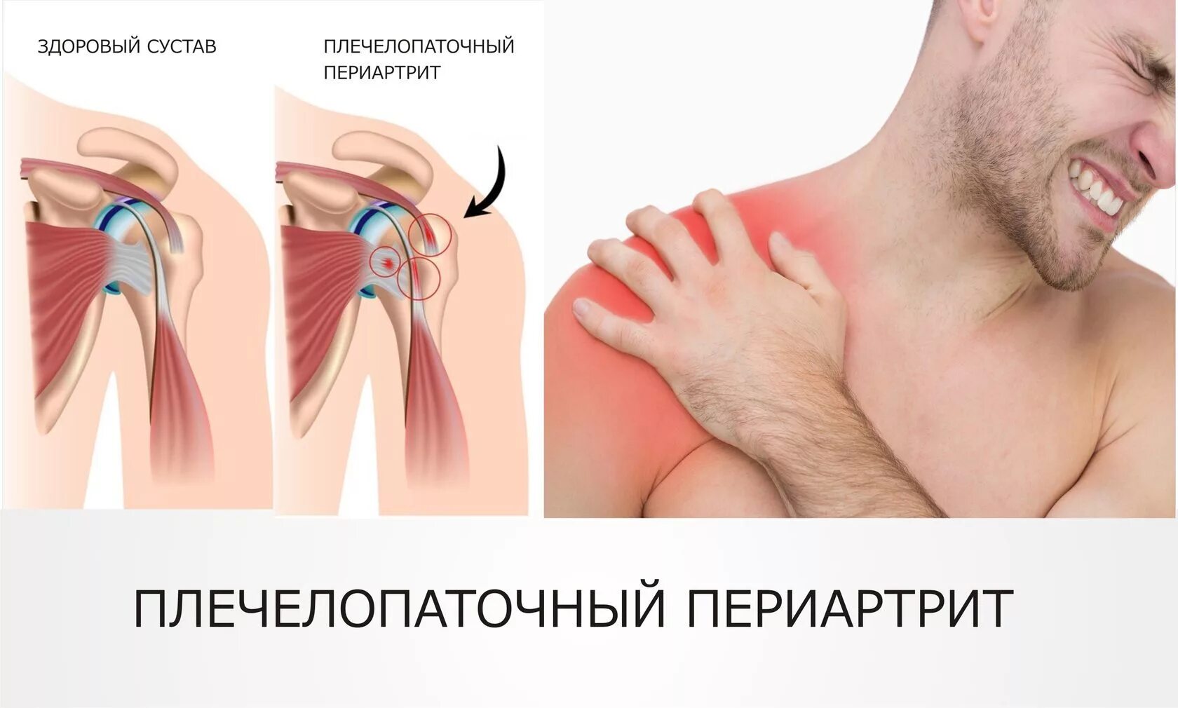 Синдром плечелопаточный периартрит. Плечевой лопаточный периартроз. Плечелопаточный периартрит периартроз. Плечелопаточный периартрит (плечевой синдром),.