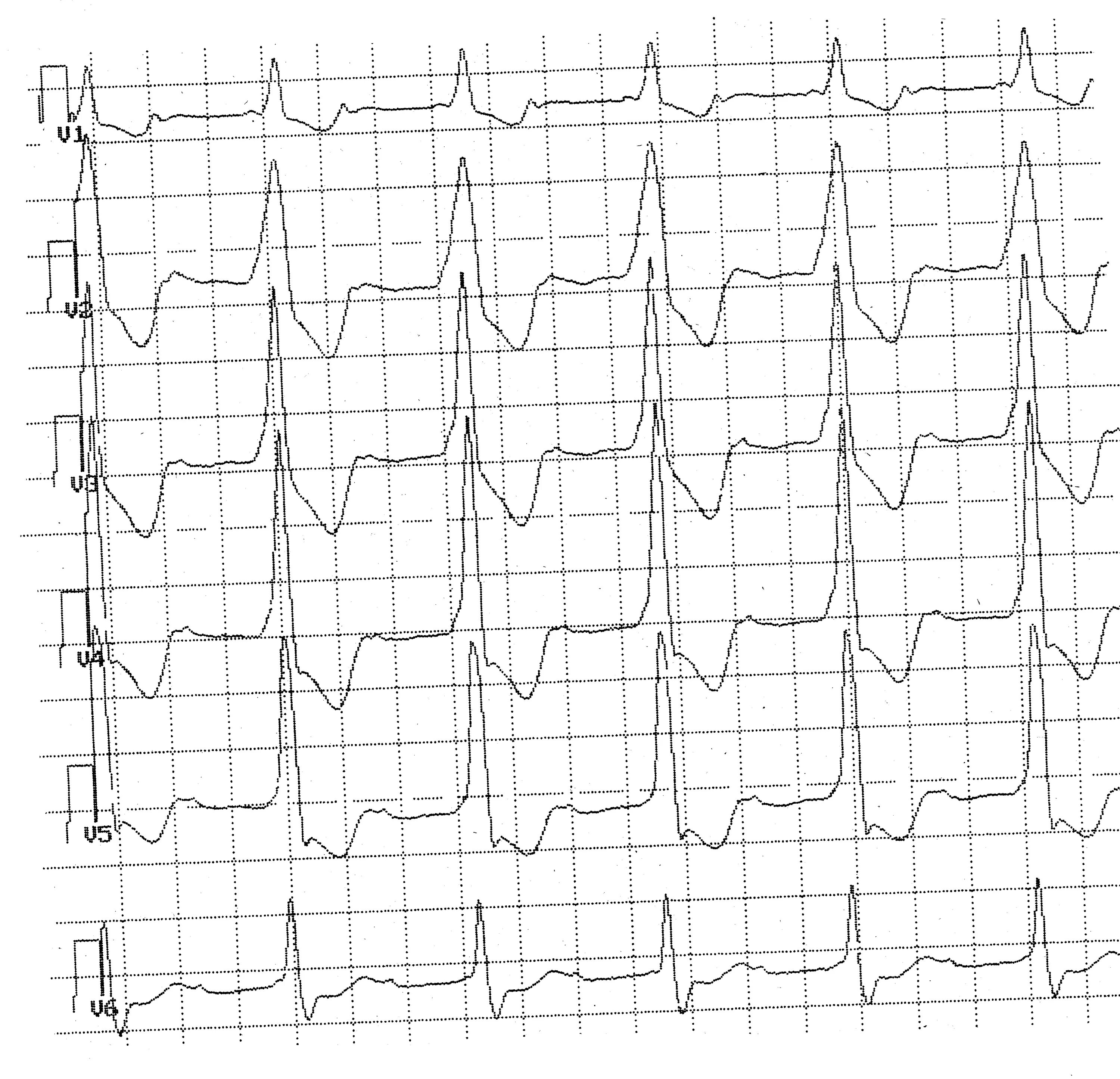 Qrs m 30. Уширенный комплекс qrs. комплекс qrs зазубрен. уширенный qrs avl i. уширение комплекса qrs.