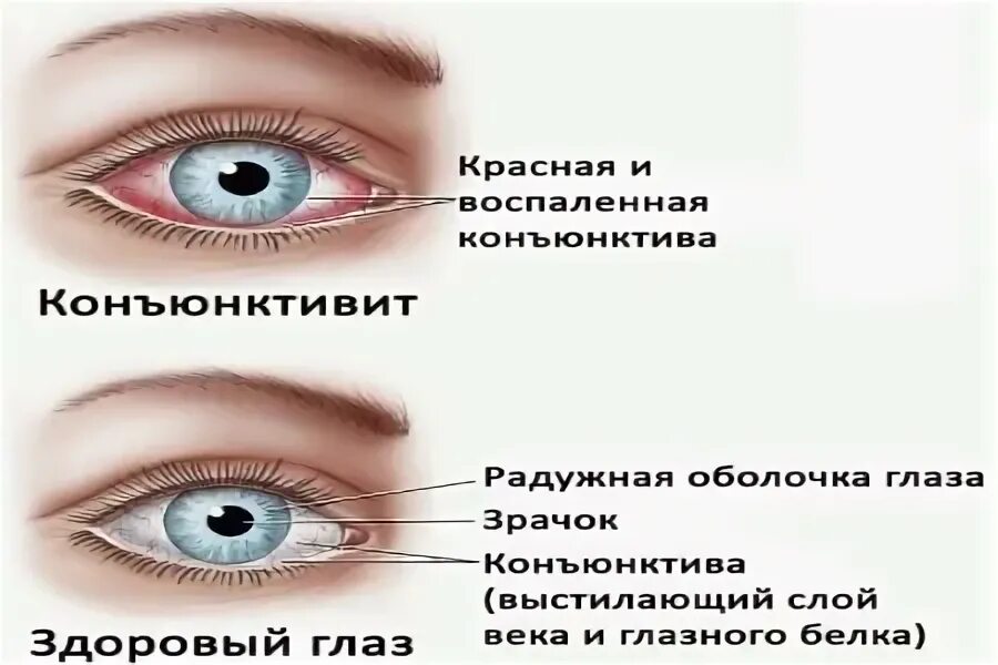 Конъюнктивит чем промывать взрослому. Конъюнктивит глаза гноятся. Конъюнктивит гнойные выделения. Вирусный конъюнктивит симптомы. Вирусный конъюнктивит у детей.