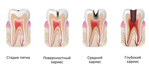 Пульпит степени