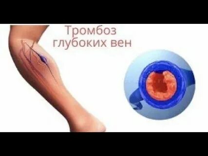 Сколько лечится тромбоз