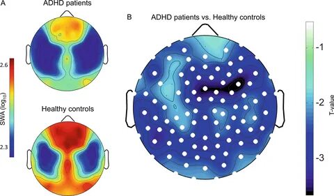 Adhd что это