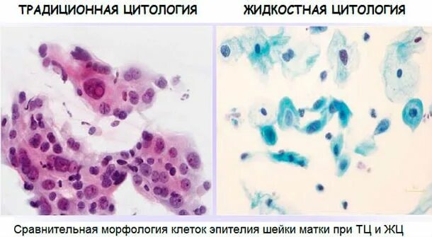 Цитологический анализ шейки. Цитологическое исследование эпителия шейки матки. Цитологическое исследование на атипичные клетки. Метаплазированный эпителий шейки. Традиционная цитология шейки матки.