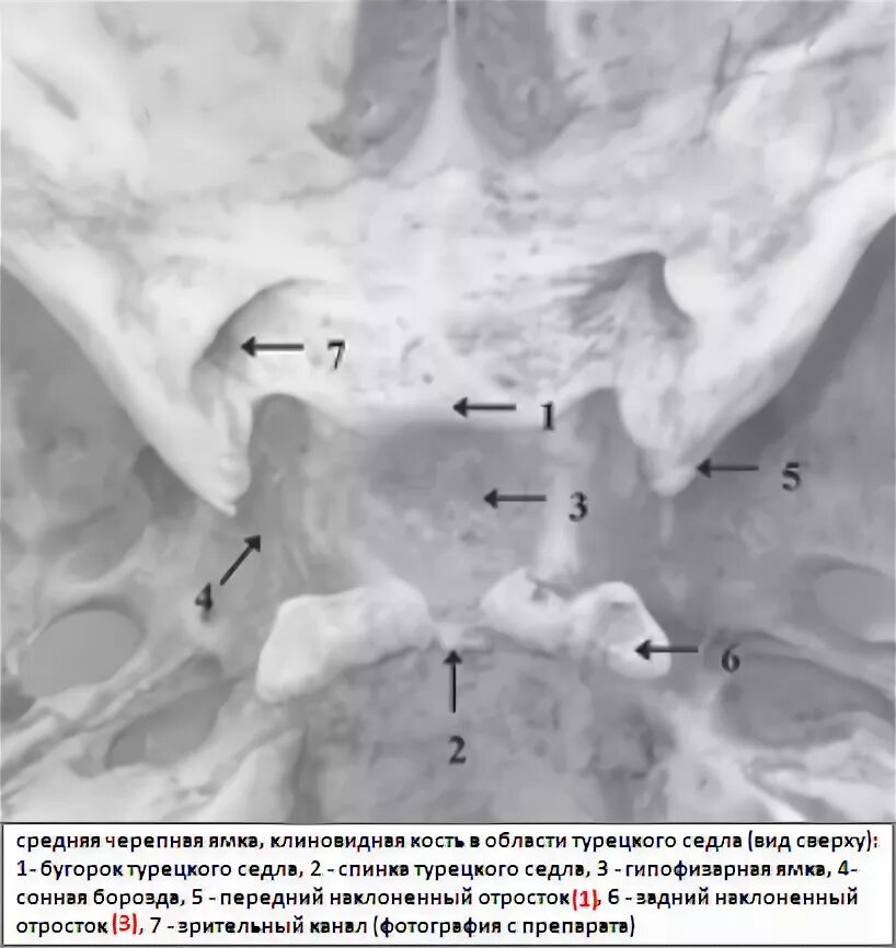 Турецкие седло кость. Клиновидная кость аномалии. Анатомия турецкого седла на кт. Турецкое седло анатомия черепа. Анатомия клиновидной кости на кт.