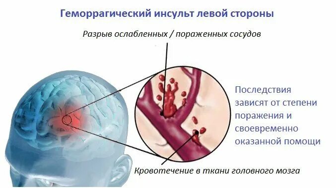 Инсульт геморрагический правая. Инсульт. Геморрагический инсульт. Инсульт левой стороны. Инсульт геморрагический левая сторона.