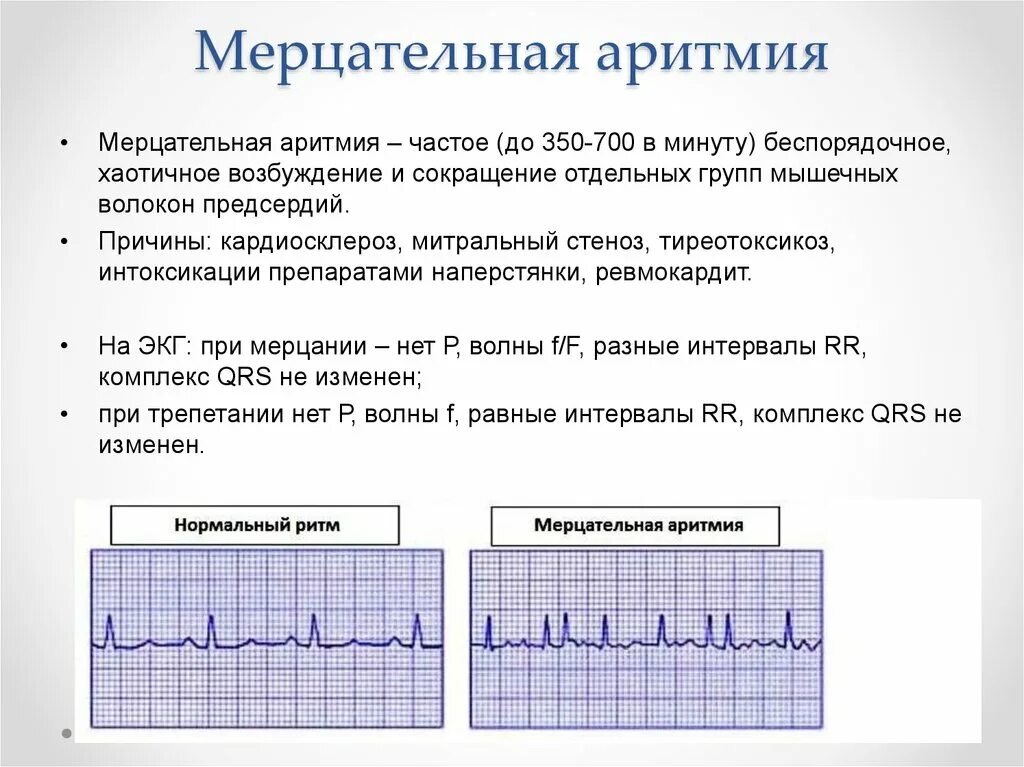 Мерцательная аритмия тахисистолическая форма ЭКГ. Симптомы фибрилляции предсердий Мерцательная аритмия. ЭКГ признаки фибрилляции фибрилляция предсердий. ЭКГ признаки мерцательной аритмии. Предсердие болезни