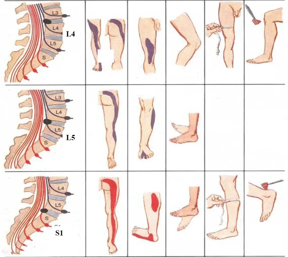 Позвоночник отдел l3 s1. Радикулопатия л5. Радикулопатия l4-l5. Радикулопатия s1 корешка. Радикулопатия s1.