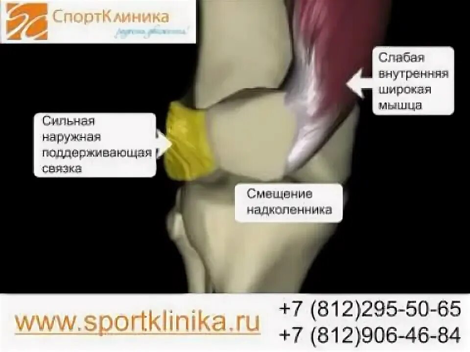 Как выглядит коленный эндопротез для тотального эндопротезирования. Стабилизация надколенника. Стабилизация надколенника. Otto bock ортез коленный. Стабилизация надколенника.
