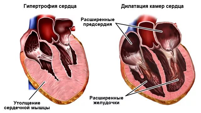 Расширение полостей сердца дилатация. Гипертрофия миокарда и дилатация полостей сердца. Миогенное расширение полостей сердца. Дилатация желудочков сердца. Миокард левого предсердия