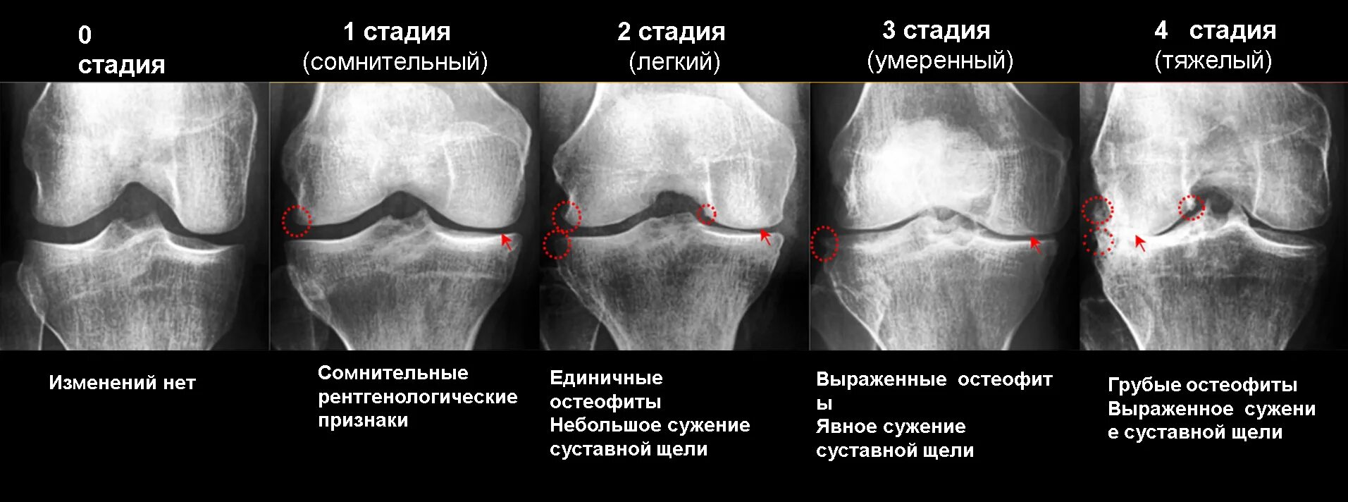 Сустав 1а. Келлгрен Лоуренс. Гонартроз стадии по Келлгрену. Артроз по Kellgren Lawrence. Остеоартроз классификация.