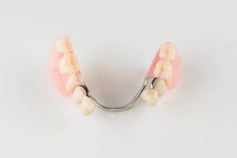 Бюгельный протез а16. Зубные протезы съемные. Съёмный зубной протез на крючках. Бюгельный и пластиночный протез. 07.