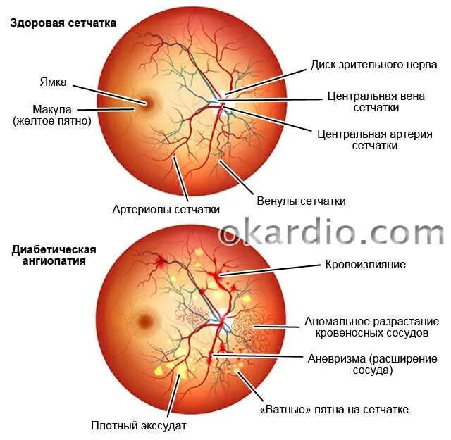 Ангиопатия и ретинопатия сетчатки. Гипертоническая ангиопатия и ретинопатия. Диабетическая офтальмопатия глазное дно. Гипертоническая ангиопатия сетчатки диагноз. Диагноз сетчатки