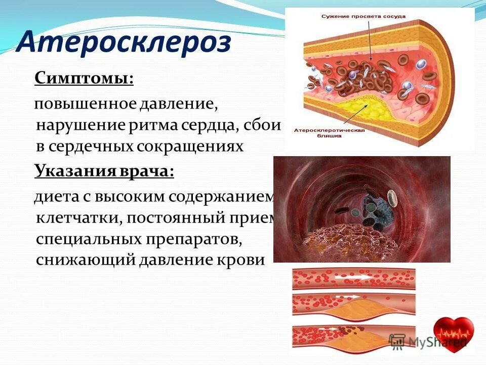 Атеросклероз сердечно-сосудистая патология. Атеросклероз симптомы атеросклероз симптомы. Атеросклеротическая болезнь сердца. Атеросколетическая болезньсердца. Эффективные лечения атеросклероза