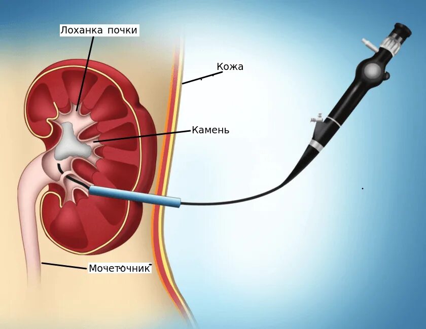 Катетер в почке