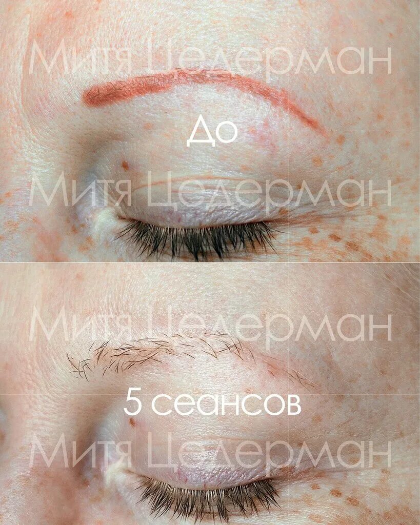 татуаж бровей оранжевый. удалить перманентный макияж бровей лазером. ремувер для перманентного макияжа. татуаж бровей лазером. брови после удаления татуажа лазером.