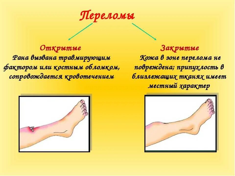 Как отличить ушиб от трещины