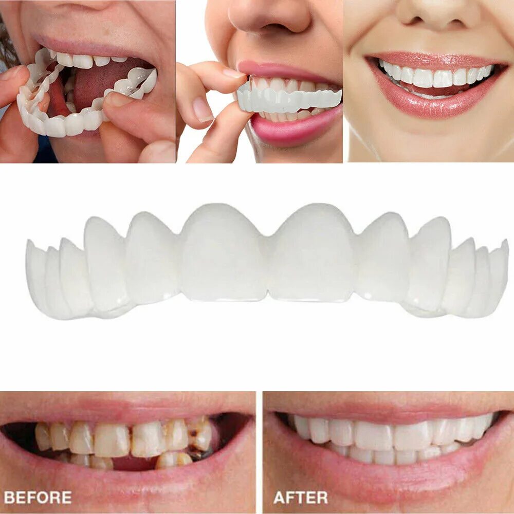 Как ставятся виниры на зубы. Виниры-элайнеры snap-on smile. накладные зубы виниры. элайнеры виниры для зубов.