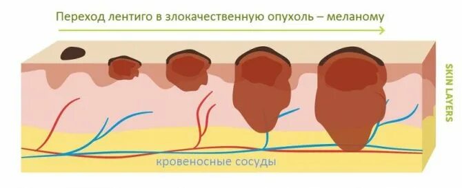 Что находится внутри родинки ВПЧ: симптомы, диагностика и лечение папиллом на теле