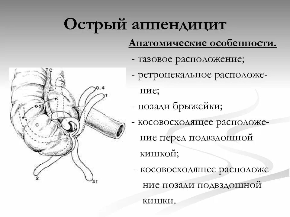 Локализация острого аппендицита. Острый аппендицит расположение. Типы расположения червеобразного отростка. Расположение червеобразного отростка.