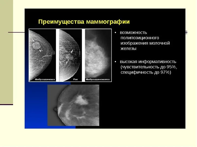 Маммография обязательно. Маммография. Маммограмма молочных желез. Маммография молочных желёз.