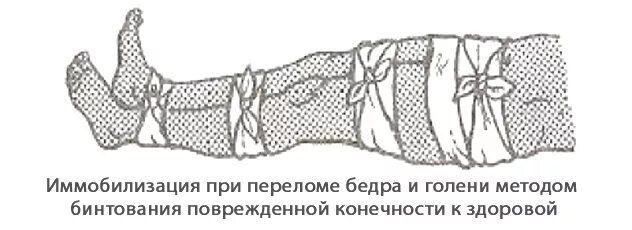 Иммобилизация предплечья при переломе голени. Диафизарный перелом голени иммоби. иммобилизация перелома диафиза бедра. границы транспортной иммобилизации при переломе бедра. иммобилизация при переломе голени.