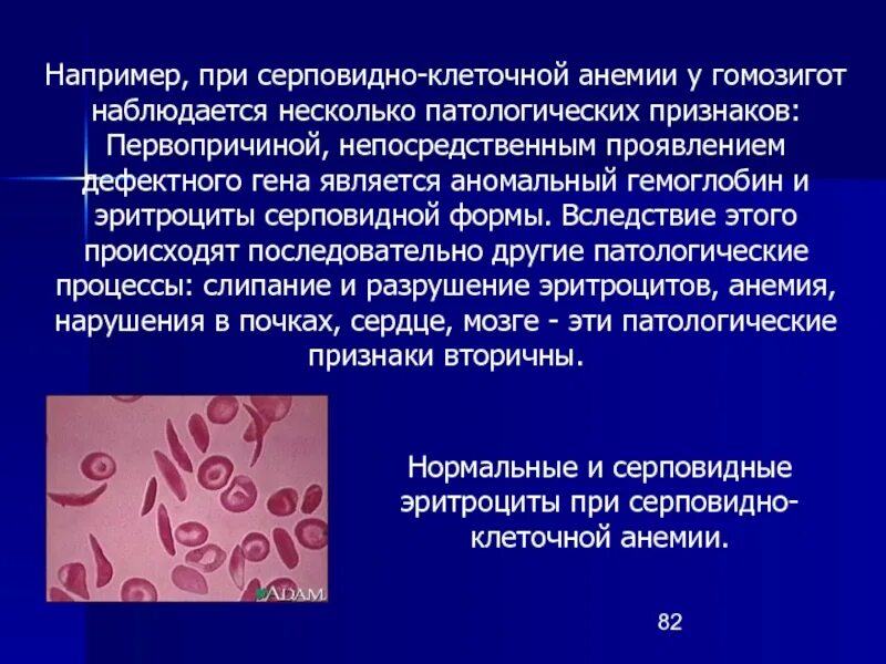 Ген серповидноклеточной анемии. Серповидная анемия эритроциты. Гемоглобин серповидноклеточная анемия. Кариотип больного серповидно клеточной анемии. При серповидно-клеточной анемии гемоглобин:.