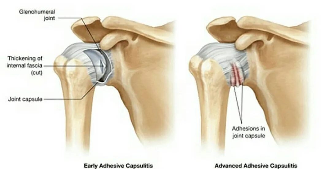 Как лечить капсулит. Адгезивный капсулит плеча. Адгезивный капсулит плечевого сустава мрт. Адгезивный капсулит плечевого сустава блокада. Капсулит замороженное плечо.