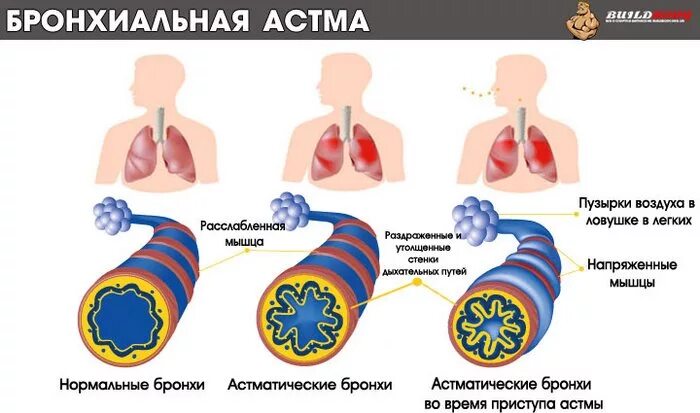 Кашель воздух дыхание. Изменение бронхов при бронхиальной астме. Обструкция дыхательных путей бронхиальная астма. Легкий приступ бронхиальной астмы. Бронхиальная астма легкие.