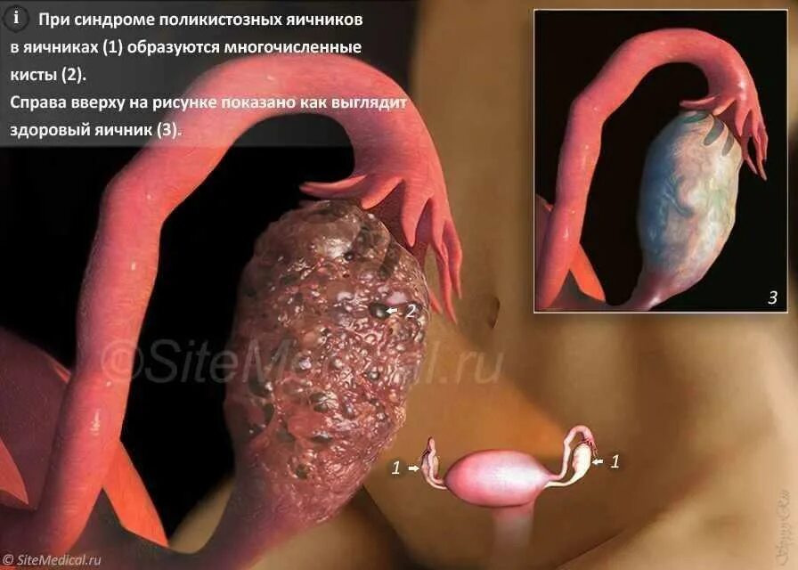 Как выглядит поликистоз яичников. Синдром поликистоза яичников. пкя – поликистозные яичники. (синдром поликистозных яичников, синдром штейна-левенталя). синдром штейна-левенталя (поликистоз яичников).