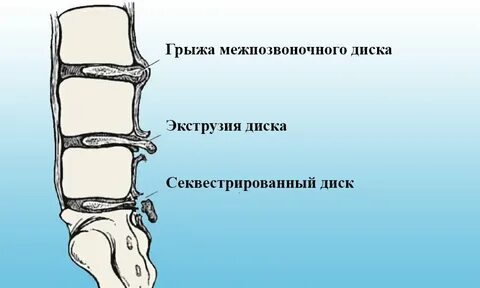Лечение секвестрированной грыжи без операции