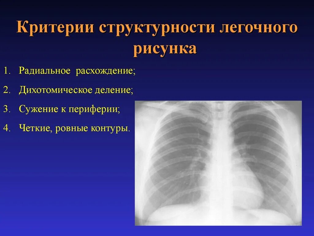 Легочный рисунок усилен. Патология легочного рисунка. Усиление легочного рисунка. Усиленный легочный рисунок.