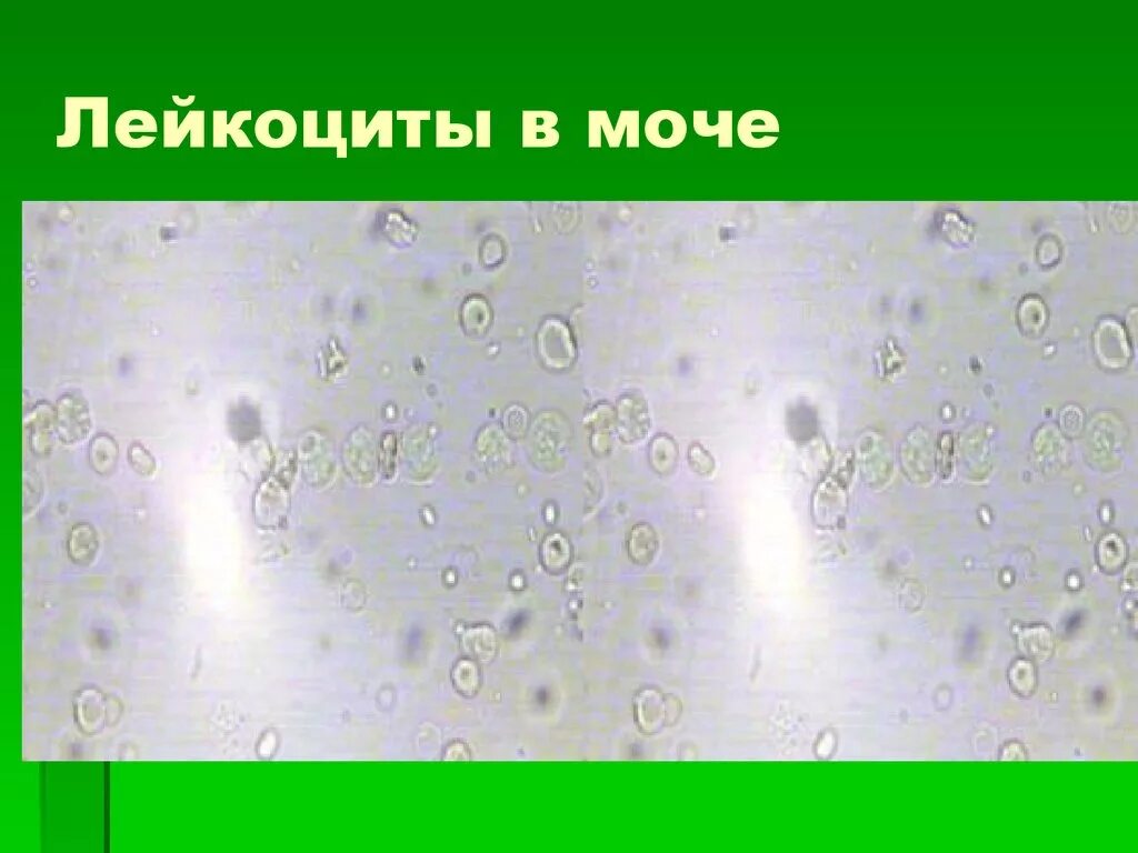 Лейкоциты в моче. Лейкоциты в моче в моче. Лейкоциты и эритроциты в моче. Лейкоциты в моче в микроскопе.
