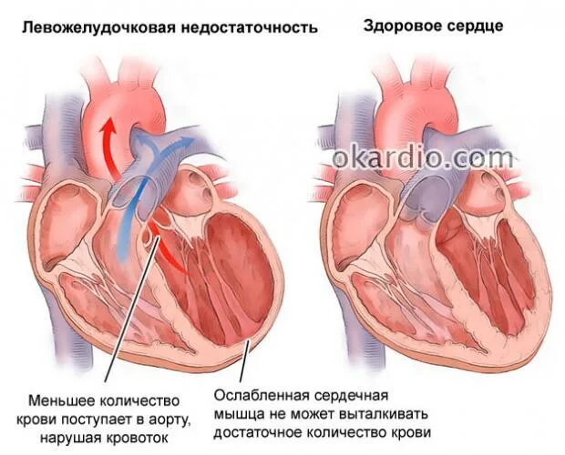 Сколько живут с кардиостимулятором. ЭХОКГ при кардиостимуляторе. Кардиостимулятор сердца. Операция по установке стимулятора сердца. Кардиостимулятор на УЗИ сердца.