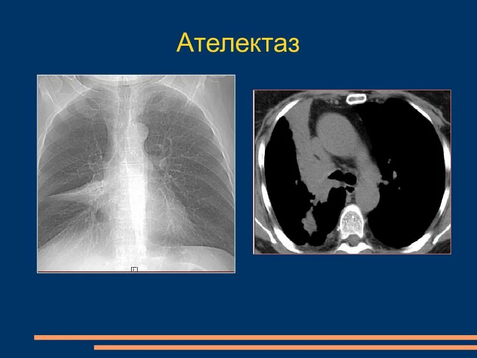 Спадение бронха